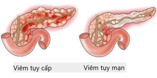 Dấu hiệu nhận biết viêm tụy sớm