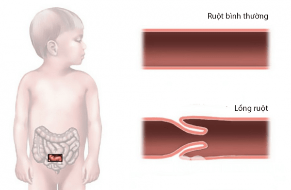 Lồng ruột ở trẻ em