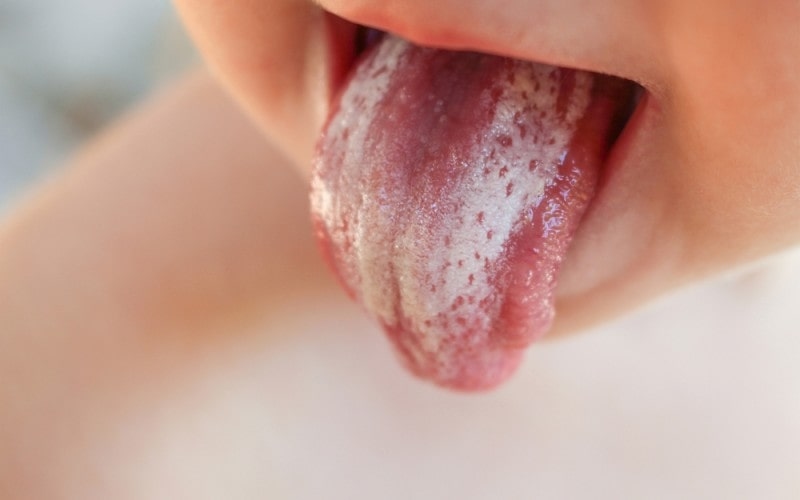 Trẻ bị nấm lưỡi khám ở đâu? trẻ sơ sinh và trẻ nhỏ