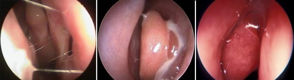 Sung huyết mũi có thể do nhiều yếu tố gây ra như môi trường, khối u trong mũi, nhiễm trùng xoang, người bị bệnh cao huyết áp hay thói quen ngoáy mũi và vệ sinh mũi không đúng cách.
