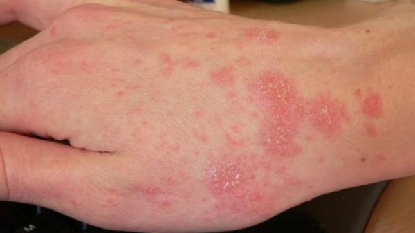 phòng khám Thu Cúc quận Cầu Giấy khám cà điều trị bệnh da liễu hiệu quả
