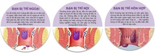 Bệnh viện Thu Cúc khám chữa và điều trị bệnh trĩ hiệu quả