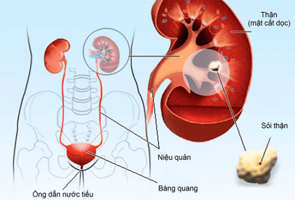 Tán sỏi ngoài cơ thể, phương pháp ưu việt đặc trị sỏi tiết niệu KHÔNG đau, KHÔNG phẫu thuật!