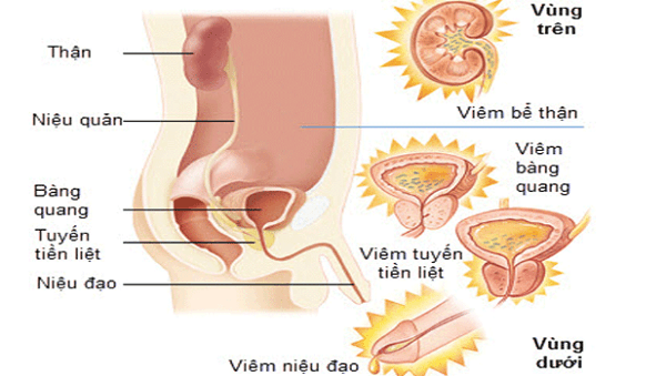 Hình ảnh mô tả viêm đường tiết niệu.