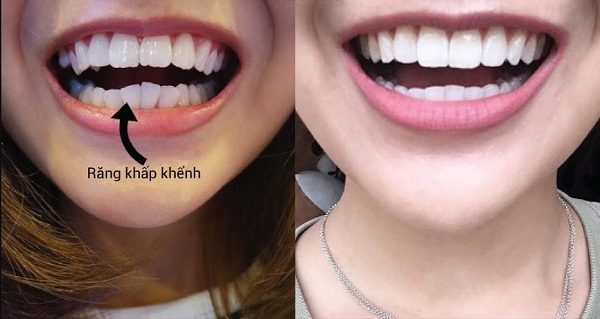nẹp răng thẩm mỹ