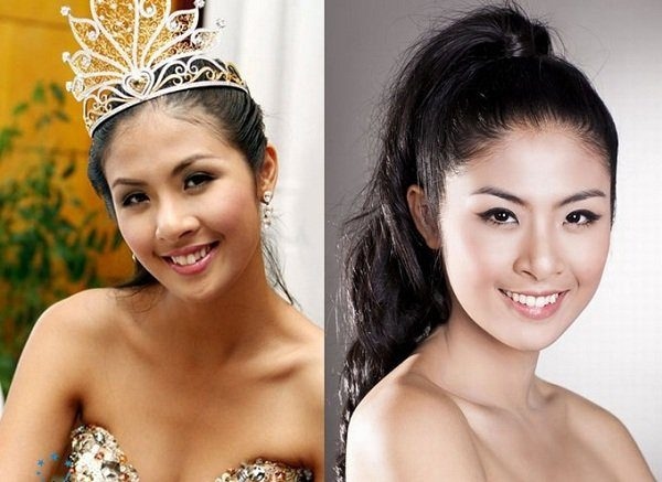 niềng răng mắc cài