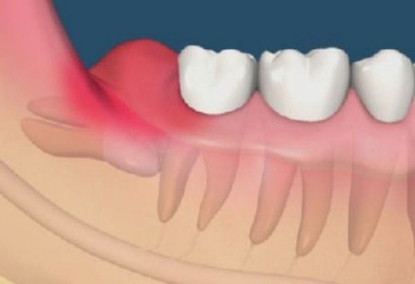 Răng khôn mọc cũng là một trong những nguyên nhân gây đau răng khi nhai