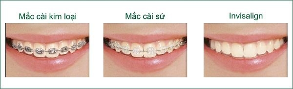 tìm hiểu về nắn chỉnh răng thu cúc