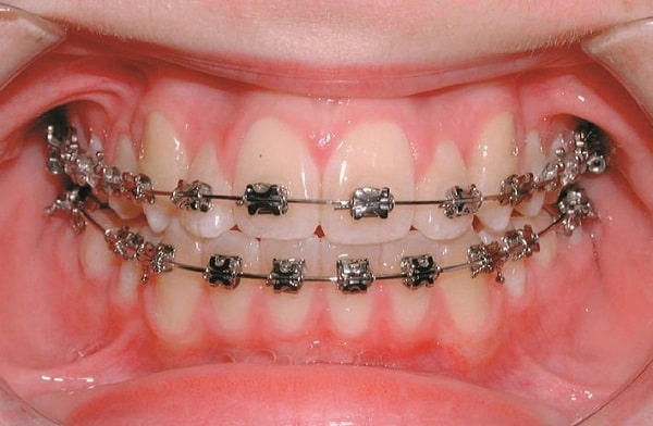 Tìm hiểu về nắn chỉnh răng &#8211; Bí quyết sở hữu răng