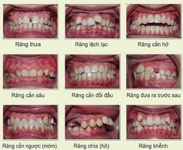tìm hiểu về niềng răng