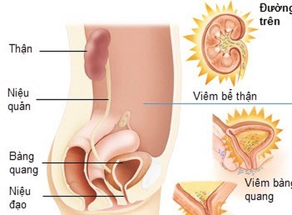 Hình ảnh mô tả viêm đường tiết niệu ở nữ giới.