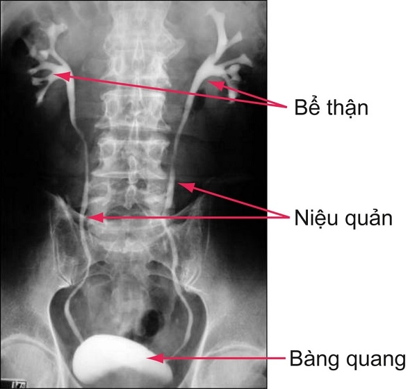 Vị trí sỏi tiết niệu khi chụp x quang thận thường.