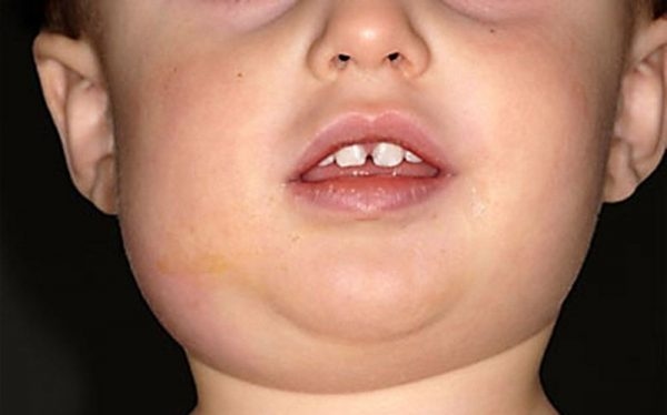 Bệnh quai bị ở trẻ em do virus gây ra, có thể biến chứng vô sinh nếu trẻ không được chăm sóc tốt và điều trị hiệu quả.