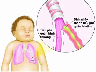 Cần lưu ý 6 bệnh do virus gây ra cho trẻ mùa trung thu