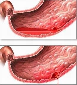 Xuất huyết tiêu hóa ở trẻ em là tình trạng chảy máu tại đường tiêu hóa.
