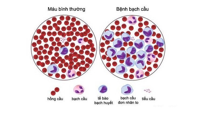 Bạch cầu trong máu cao hay thấp đều cảnh báo những nguy hiểm đến sức khỏe, bạn cần chú ý