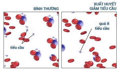 tiểu cầu bình thường là bao nhiêu