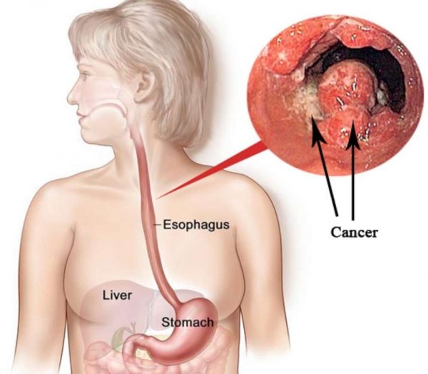 trào ngược dạ dảy thực quản dễ gây ung thư thực quản