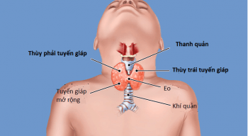 biến chứng bệnh cường giáp