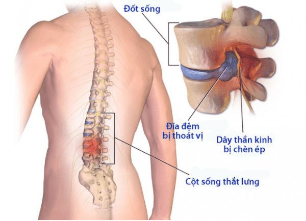 đau thắt lưng ở nam giới do thoát vị đĩa đệm
