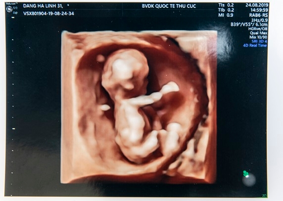 Công nghệ siêu âm 5D có những ưu điểm vượt trội hơn hẳn các thế hệ siêu âm trước đó