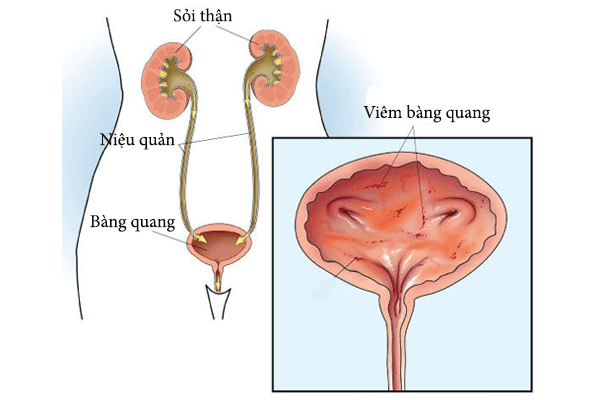 Một số bệnh lý ở bàng quang như bàng quang bị viêm nhiễm cũng là yếu tố thuận lợi gây nên sỏi bàng quang (ảnh minh họa)