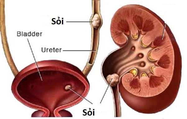emNhững viên sỏi có kích thước lớn và nhiều góc cạnh có thể kẹt lại niệu quản và gây ra nhiều biến chứng nguy hiểm cho người bệnh (ảnh minh họa)/em
