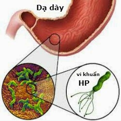 vi khuẩn HP gây triệu chứng đau dạ dày