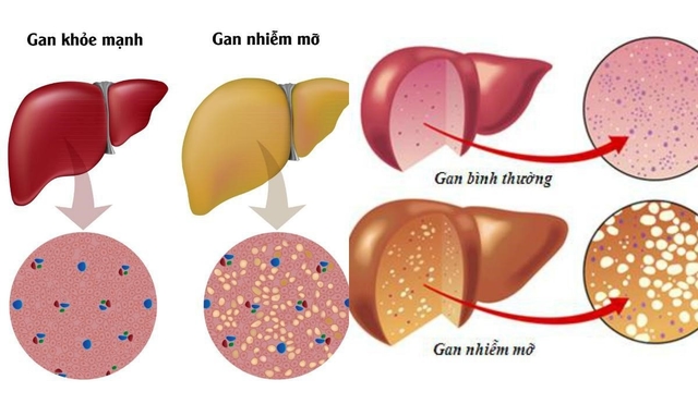 Các xét nghiệm chức năng gan phổ biến hiện nay