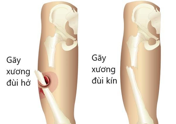Có nhiều kiểu gãy xương đùi do va đập, tai nạn...