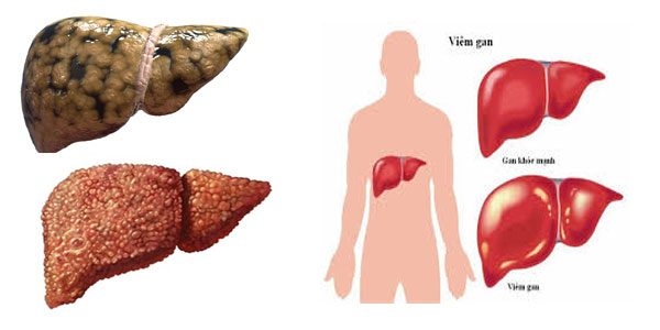 Người mắc các vấn đề về gan có thể gây ngứa khắp người. 