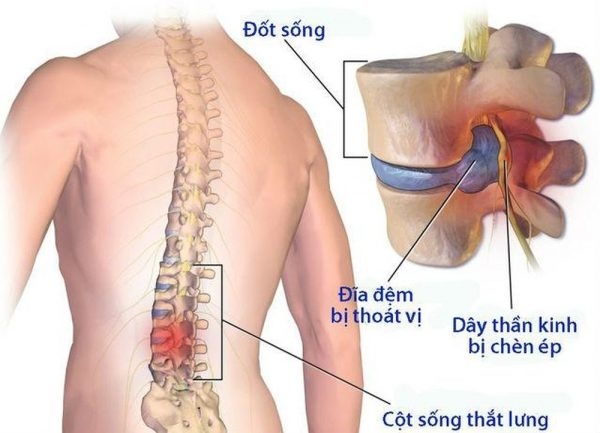 nguyên nhân đau ngang thắt lưng