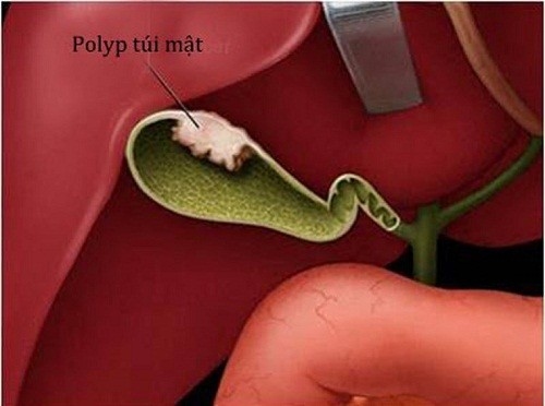 Polyp túi mật nên &#8220;chung sống hòa bình&#8221; hay là cắt bỏ?