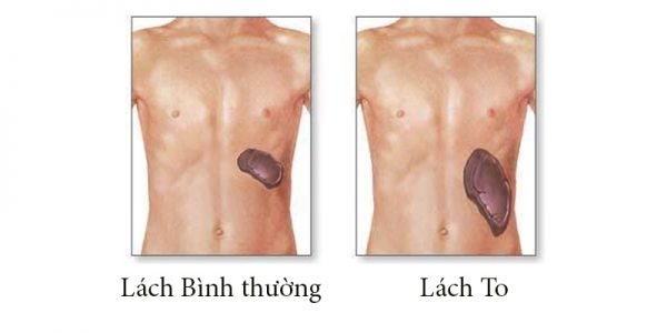 Lá lách to nếu không được thăm khám và điều trị kịp thời khi gặp phải một số chấn thương hay tác động từ bên ngoài có thể gây vỡ lách sẽ rất nguy hiểm đến tính mạng. (ảnh minh họa)