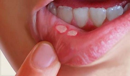 nhiệt miệng nên ăn gì