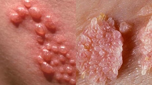 Sùi mào gà là một trong những bệnh lậu hay gặp ở nam giới qua hoạt động quan hệ tình dục không an toàn