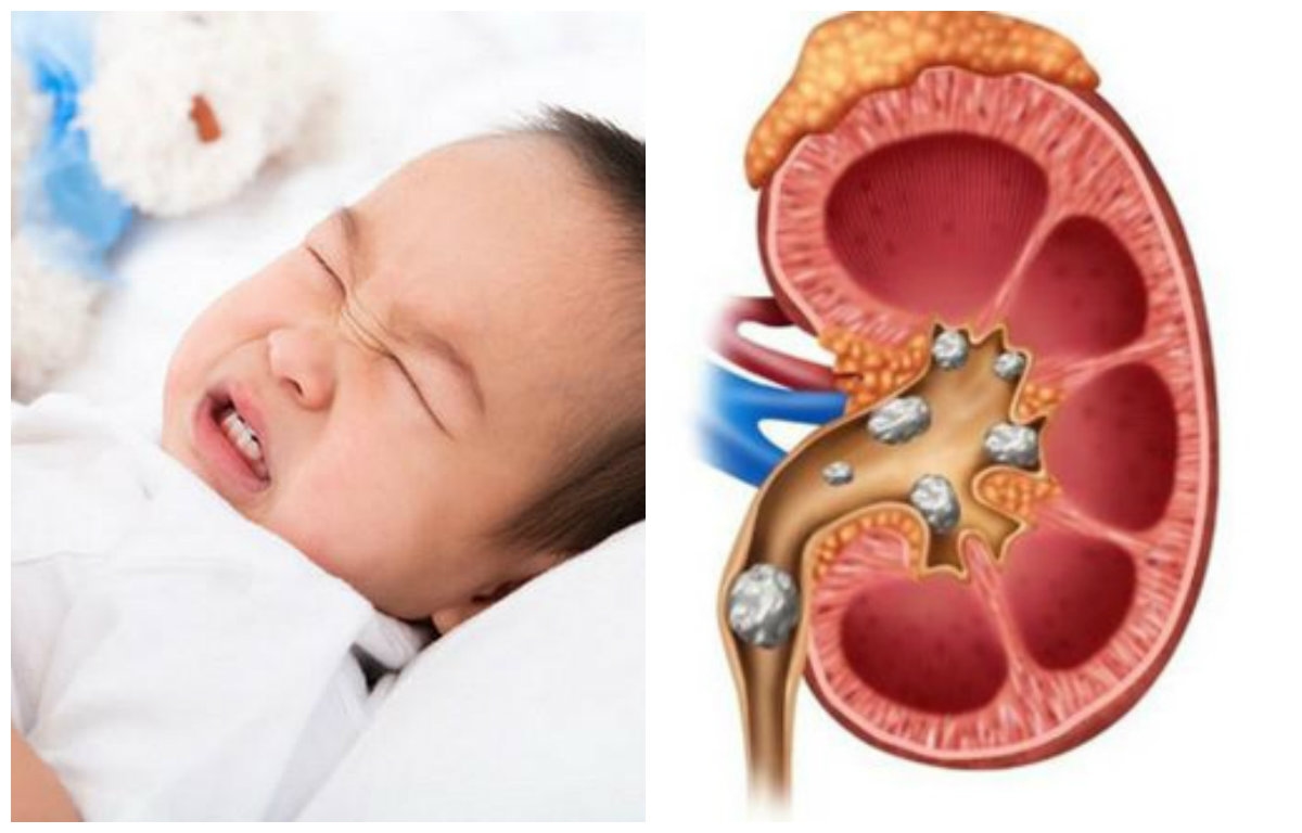 Sỏi tiết niệu ở trẻ em &#8211; những điều cần biết