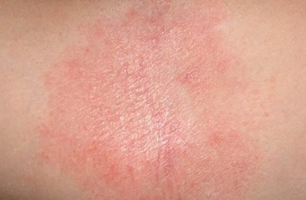 viêm da dị ứng