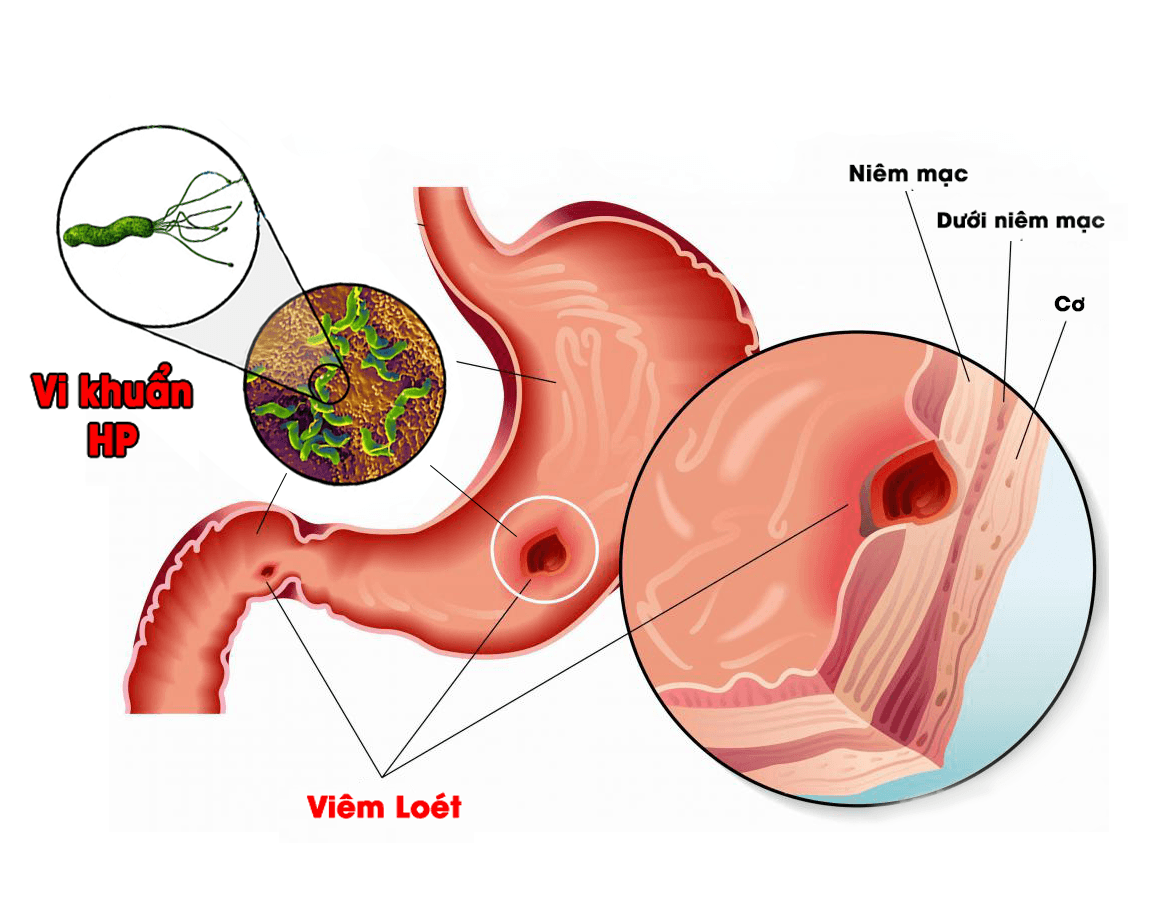Xét nghiệm vi khuẩn HP bằng cách nào?