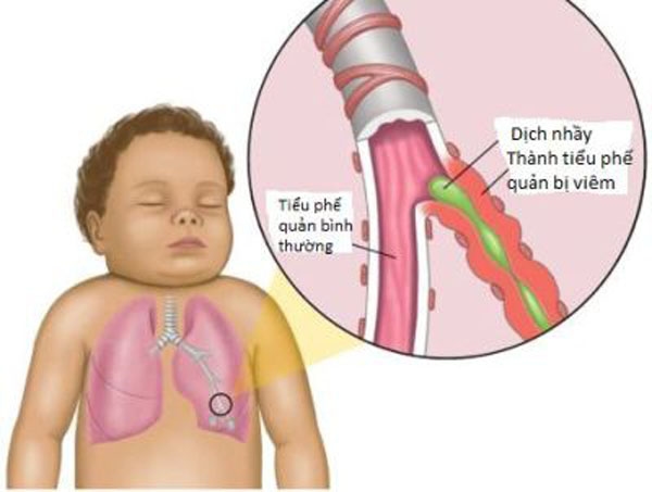 &#8220;Mách mẹ&#8221; cách phòng tránh biến chứng bệnh cảm lạnh