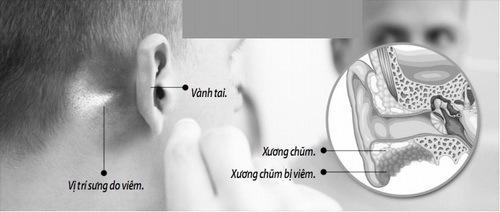 viêm tai xương chũm có nguy hiểm không