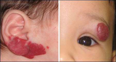 bướu máu ở trẻ em có nguy hiểm không