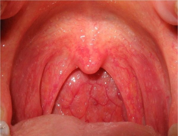 biểu hiện bệnh viêm họng bội nhiễm