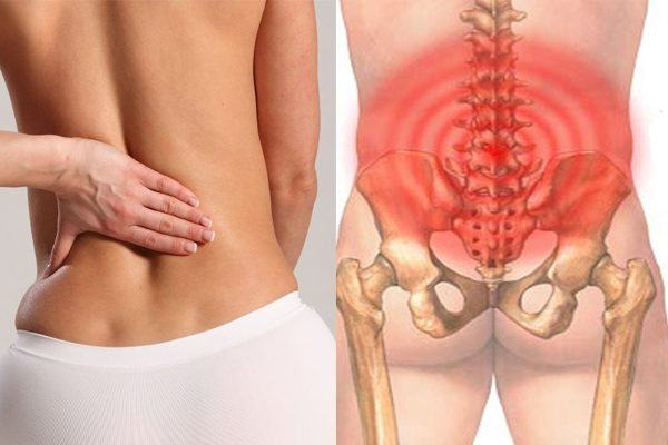 Viêm xương chậu hoặc thoát vị đĩa đệm cũng gây đau xương chậu