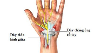 Hội chứng ống cổ tay khiến dây thần kinh chạy thẳng từ cẳng tay đến lòng bàn tay bị sưng và đau nhức.