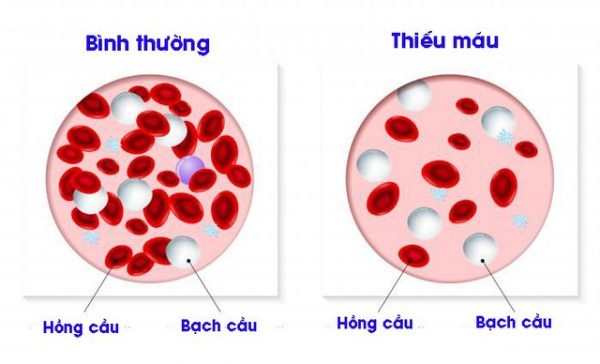 thể tích trung bình hồng cầu thấp