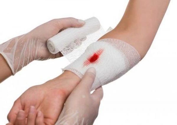 Sơ cứu vết thương gây chảy máu ngoài có cần thiết