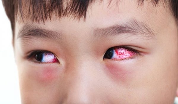 dấu hiệu trẻ bị viêm kết mạc mắt 
