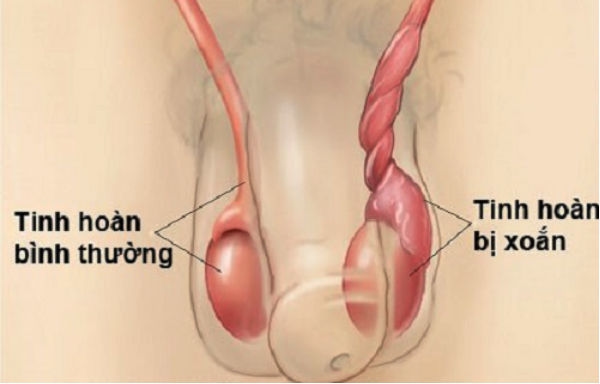 xoắn tinh hoàn ở trẻ em là gì