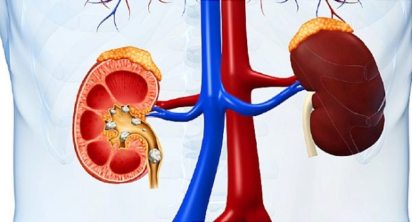 Sự thật về sỏi thận có thể bạn không biết